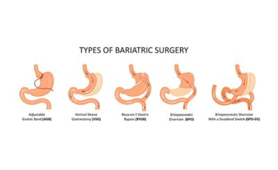 What are The Types of Bariatric Surgery?