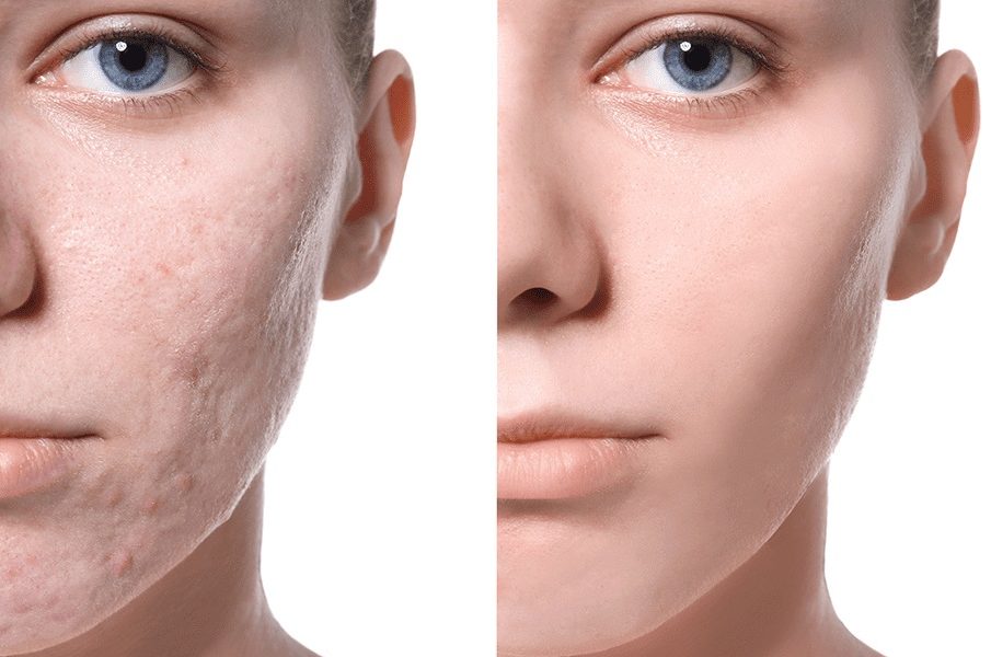 What Is The Best Facial Treatment For Acne Scars