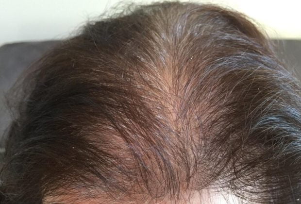 COMBATTING HAIR LOSS WITH HAIR TRANSPLANT