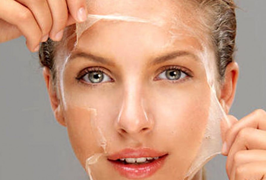 chemical peel burn treatment