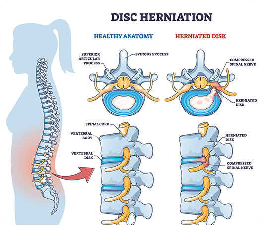 Natural Ways For Slipped Disc Treatment Healing Without Surgery 8271